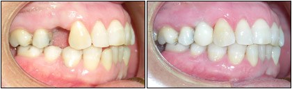 precio implantes dentales malaga