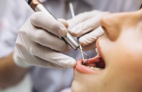 implantes dentales malaga